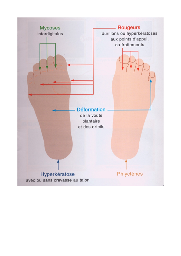 Conseils de prévention et de soins des pieds